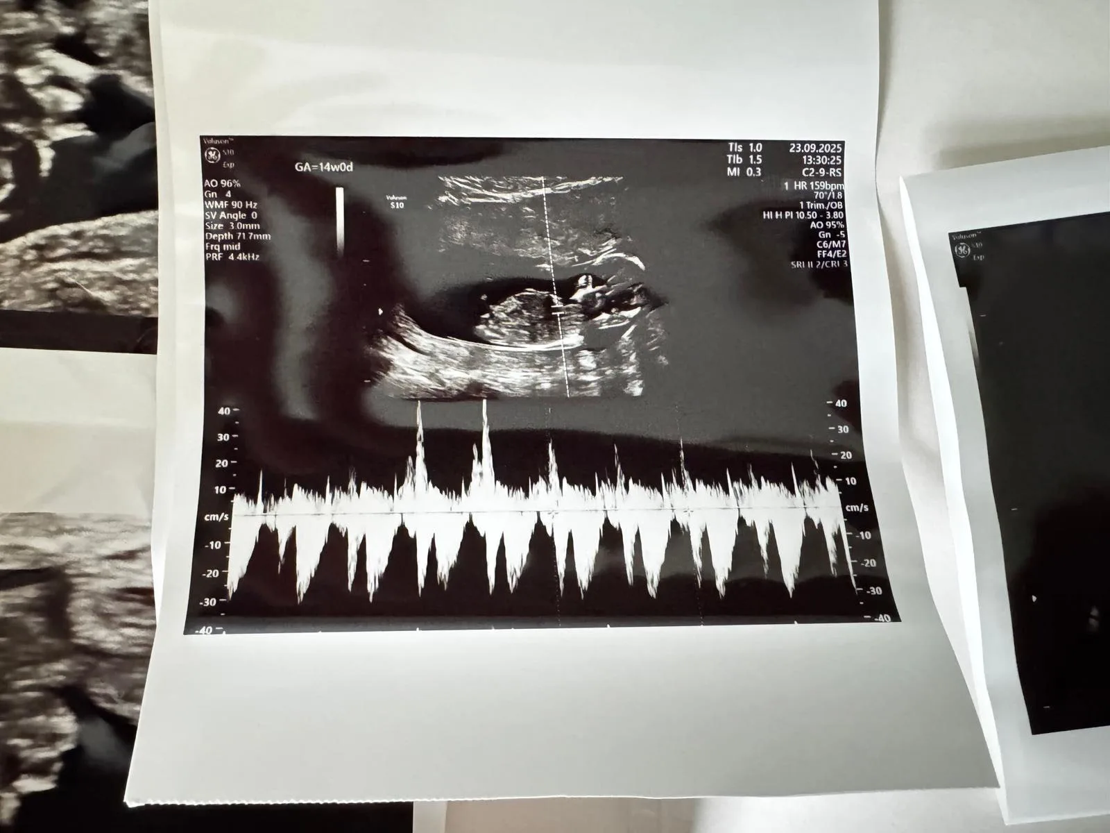 Baby echo printout showing heartbeat waveform strip